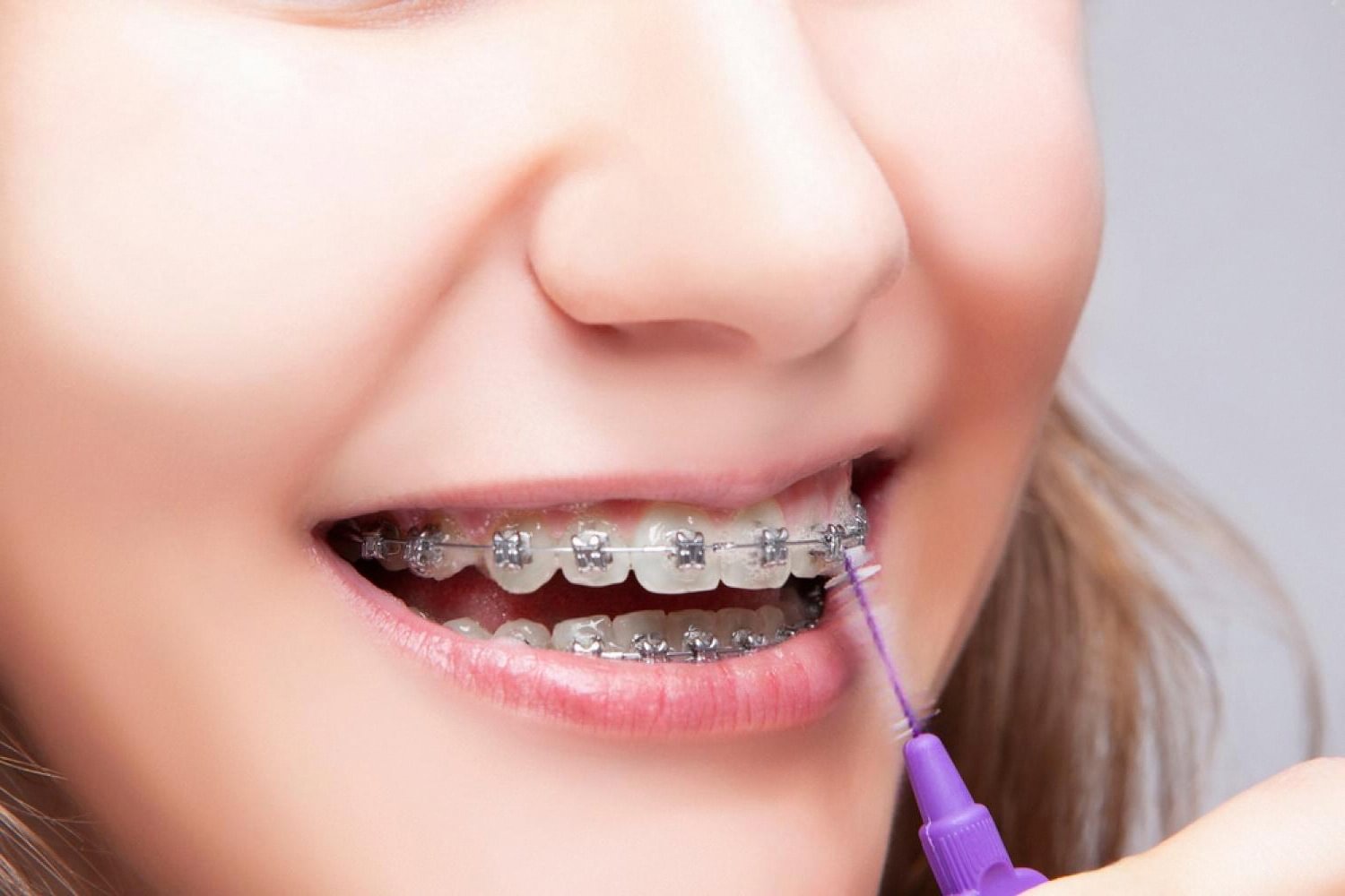 Close-up of braces being cleaned, showing bite correction progress